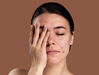 درمان لیزری BeautiDerm