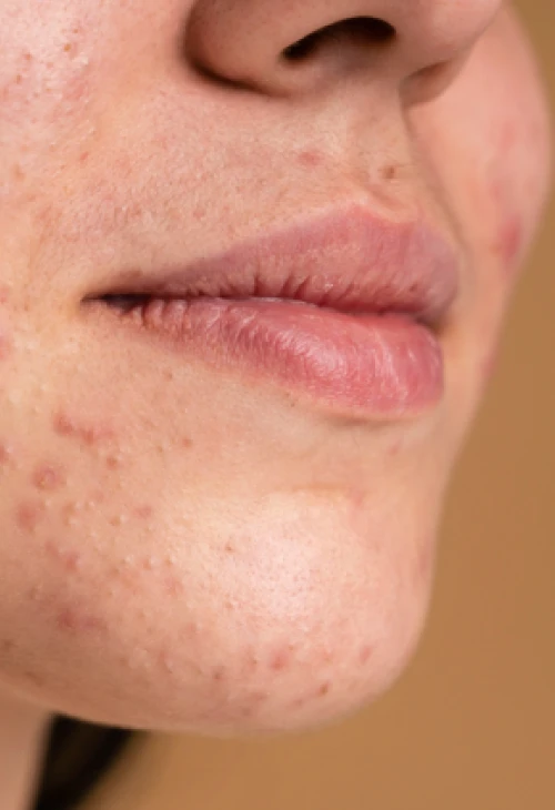 لیزر پوست BeautiDerm